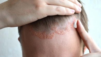 Seboreik dermatit belirtileri neler ve kimlerde görülür? Hastalığı tetikleyen besinler